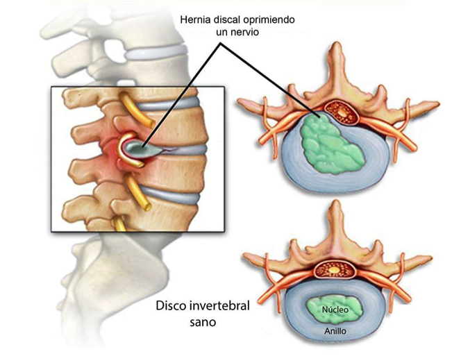 Hernia Discal Lumbar — Sara Pavón Fisioterapia 8051